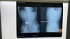 Hình ảnh cây sắt đâm thấu bụng bệnh nhân
